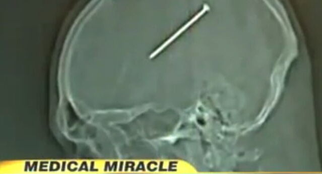 un clou dans un cerveau